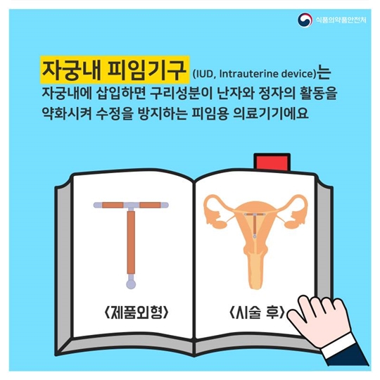 이것만은 알고 쓰자 자궁내 피임기구