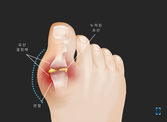 통풍.