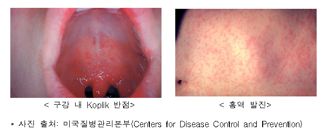 홍역.
