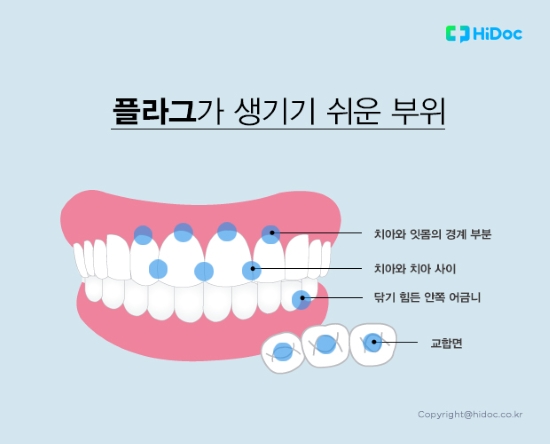 플라그가 생기기 쉬운 부위