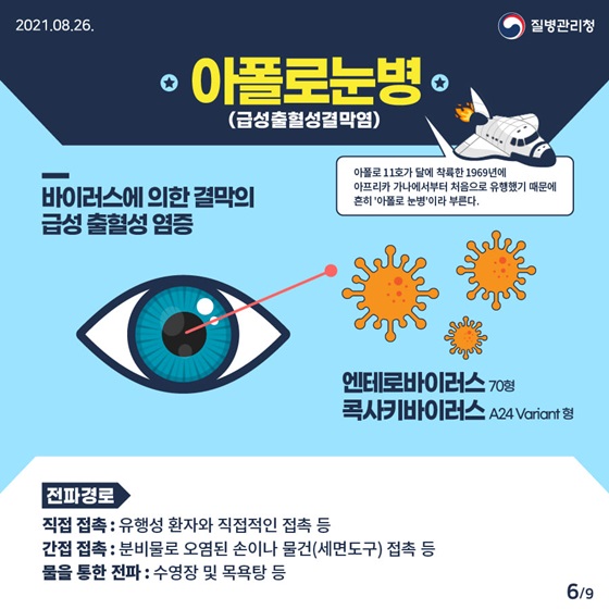 아폴로 눈병(급성출혈성결막염)