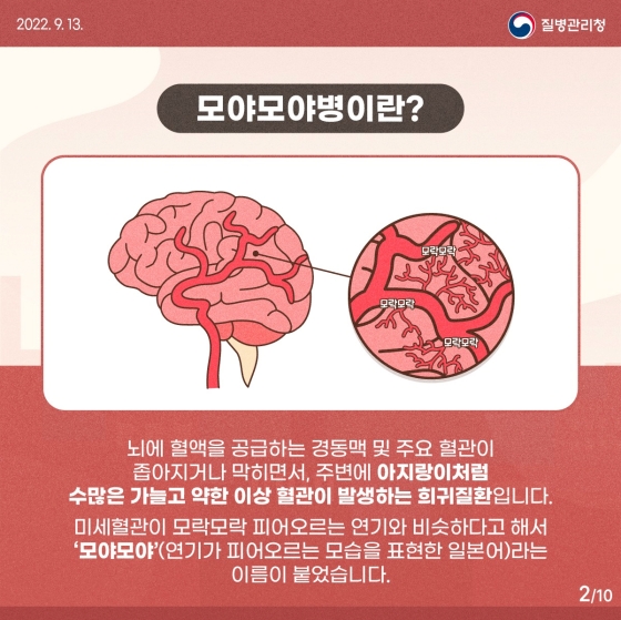 혈관이 연기처럼 모락모락, 모야모야병