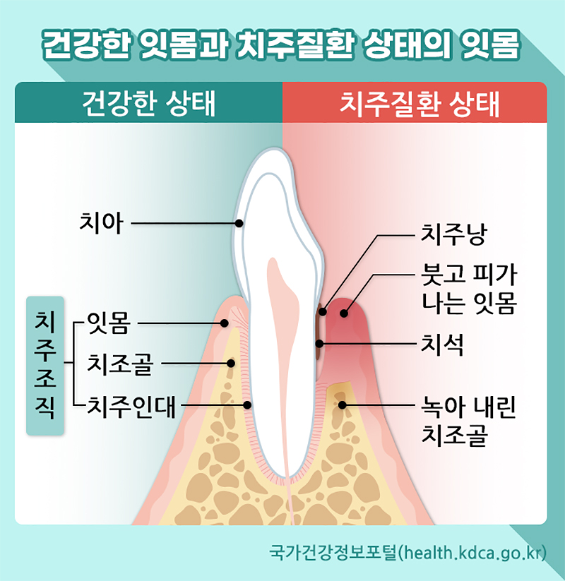 건강한 잇몸과 치주질환 상태의 잇몸