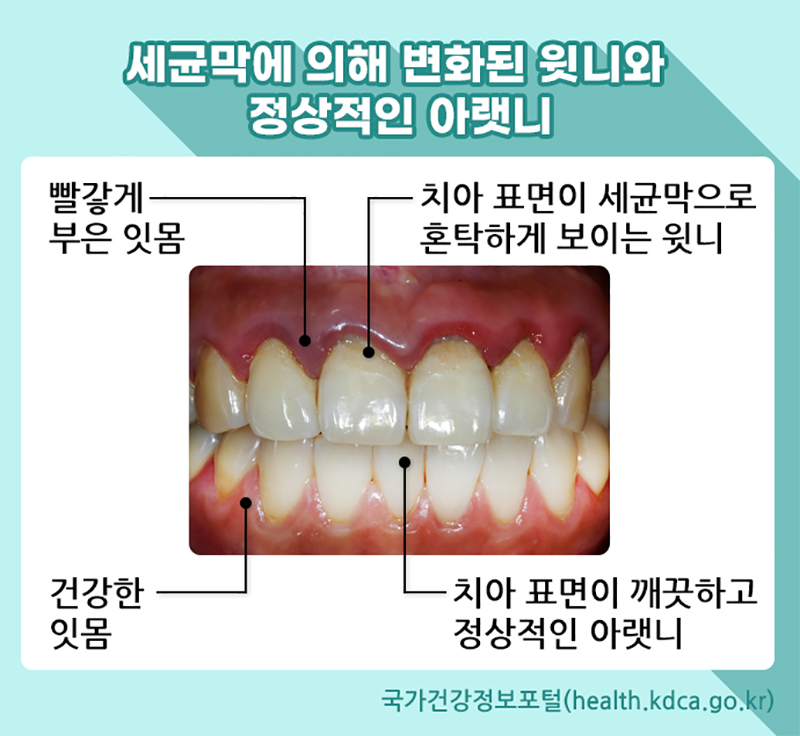 세균막에 의해 변화된 윗니와 정상적인 아랫니