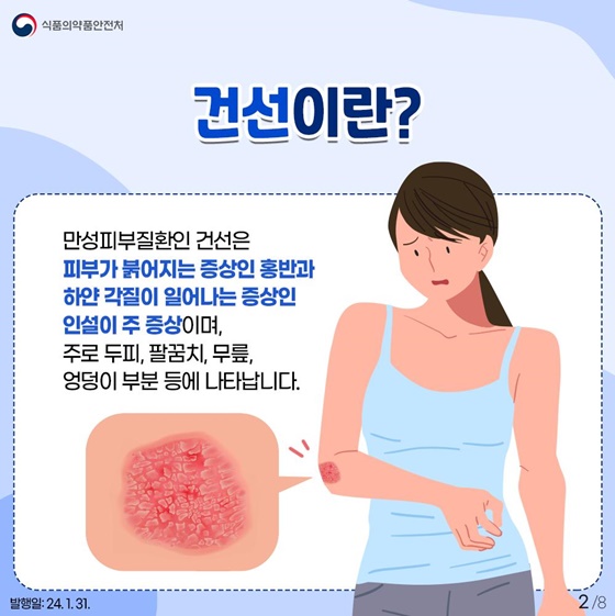 자가투여주사제 건선치료제의 안전사용법