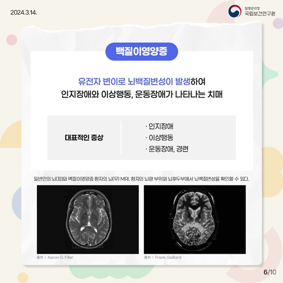 치매에는 나이가 없다？  젊은 세대도 안심할 수 없는 조발성 치매!