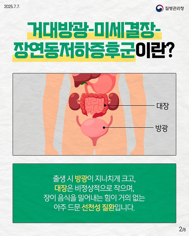 선천성 유전자 돌연변이 희귀질환 거대방광-미세결장-장연동저하증후군