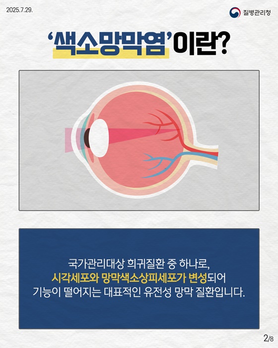 유전성 망막 질환, 색소망막염