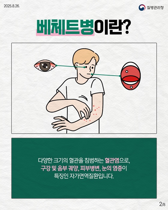 자가면역질환 베체트병