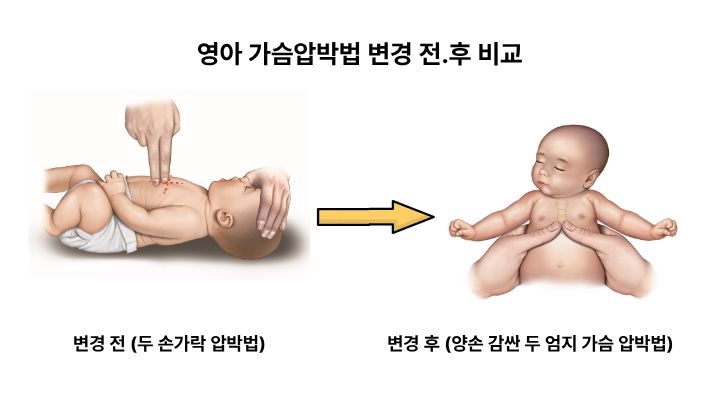새로 개정된 소아 기본 소생술에서는 '양손 감싼 두 엄지 가슴압박법'을 사용할 것을 권고했다
