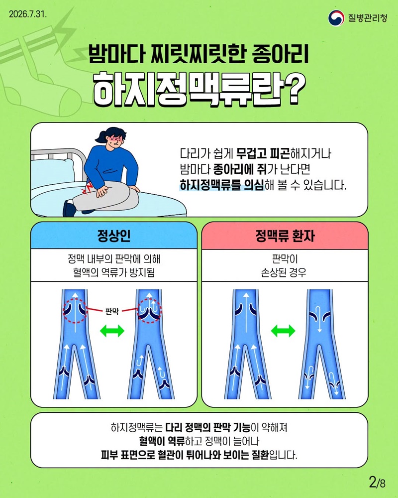 다리가 보내는 위험 신호, 하지정맥류 이렇게 관리해요